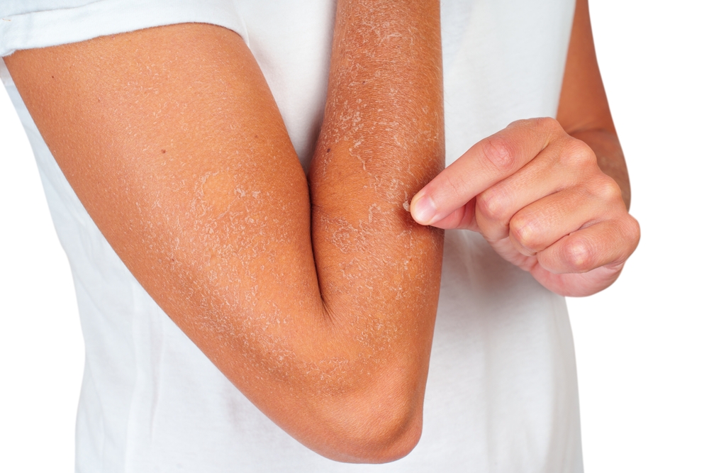 piele uscata pe brate, cojindu-se